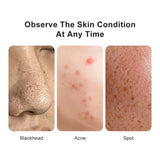 Wireless Skin Analyzer Dermatoscope | 50X-200X Magnification | Pore & Scalp Scanner
