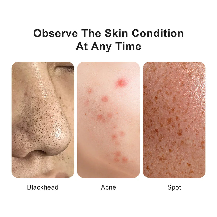 Wireless Skin Analyzer Dermatoscope | 50X-200X Magnification | Pore & Scalp Scanner